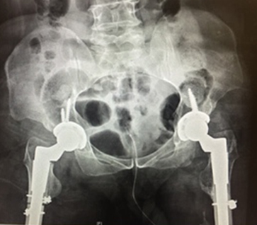 Complex hip replacement logo4