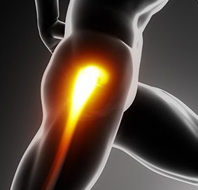Femoral Shaft Fracture 1