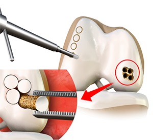 Mosaicplasty pic