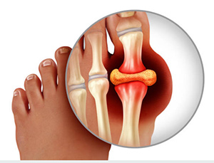 What Causes Gout?
