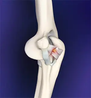 Elbow Ligament Injuries