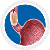 Halo Ablation for Barrett’s Esophagus - service