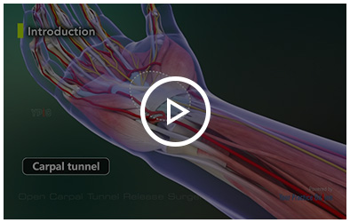 Open Carpal Tunnel Release Surgery