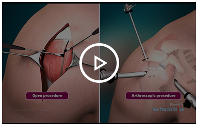 Rotator Cuff Repair