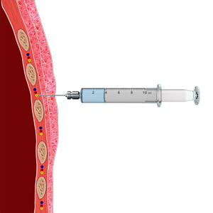 Intercostal Nerve Block
