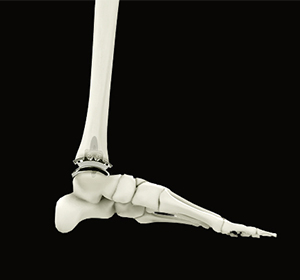 Ankle Joint Replacement img