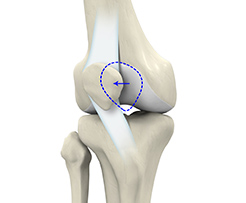 Picture of Lateral Patellar Instability