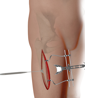Complex Hip Reconstruction Surgery1