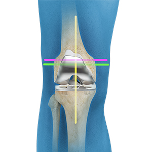 Kinematic Alignment Total Knee Replacement