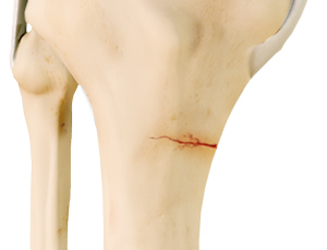 Knee Stress Fractures1