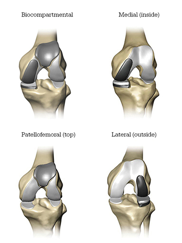 Mako Robotic-Arm Assisted knee replacement