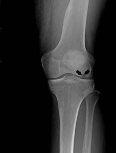 Osteonecrosis of the Knee1
