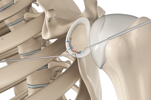 Img-Arthroscopic Bankart Repair