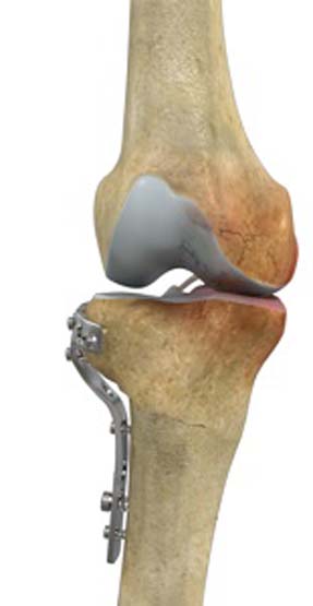 Img-High Tibial Osteotomy