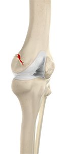 Img -Knee Fracture