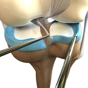 Img-Meniscal Repair Surgery