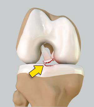 Img -Tibial Eminence Fractures