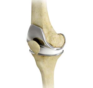 Img-Total Knee Replacement