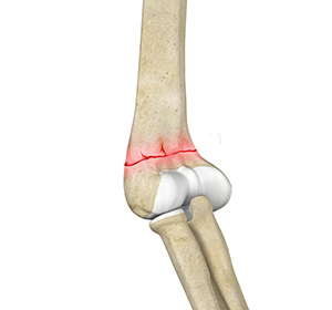 Distal Humerus Fractures of the Elbow Images