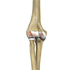Elbow Arthritis Images