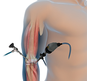 Elbow Arthroscopy Images