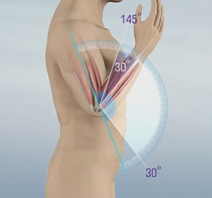 Elbow Contracture Images