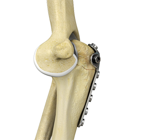 Elbow Fracture Reconstruction Images