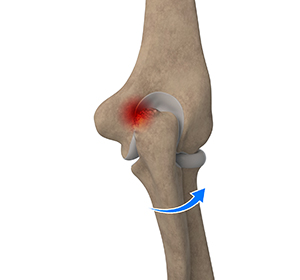 Elbow Impingement Images