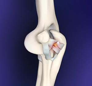 Elbow Ligament Injuries Images