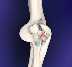 Elbow Ligament Reconstruction Images