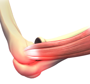 Elbow Sprain Images