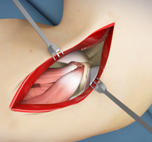 Elbow Surgery Images