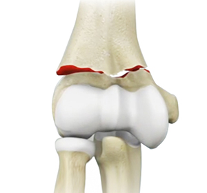 Elbow Trauma Images