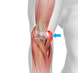 Hyperextension Injury of the Elbow Images