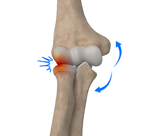 Lateral Impingement of the Elbow Images