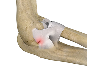 Lateral Ulnar Collateral Ligament Injuries (Elbow) Images