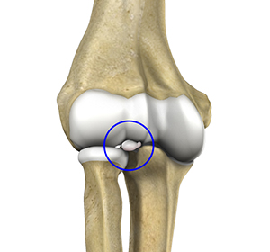 Loose Bodies in the Elbow Images