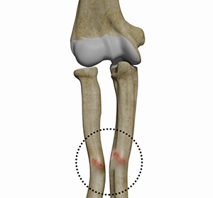 Malunion Surgery (Elbow) Images
