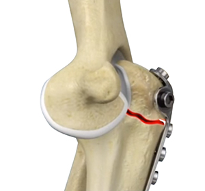 Non-union Surgery (Elbow) Images