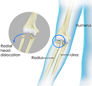Nursemaid's Elbow Images