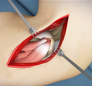 Open Elbow Surgery Images