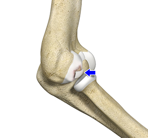 Osteochondritis Dissecans of the Elbow Images