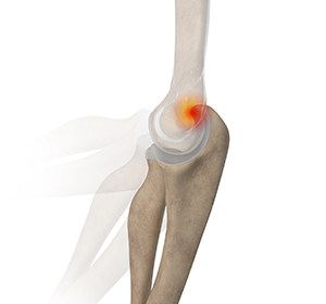 Posterior Impingement of the Elbow Images