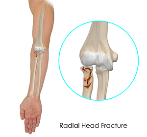 Radial Head Fractures of the Elbow Images