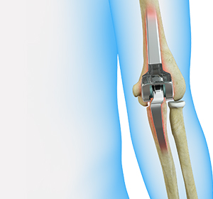 Revision Elbow Replacement Images