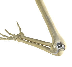 Total Elbow Replacement Images