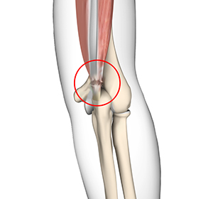 Triceps Injuries Images