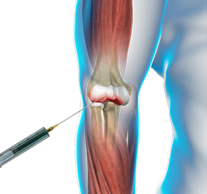 Viscosupplementation for Elbow Arthritis Images