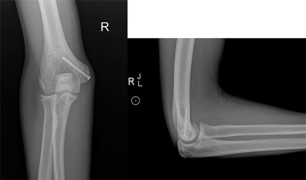 Treatment for Medial Epicondyle Avulsion Fracture 2