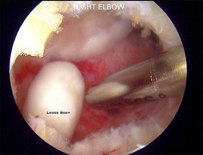 Removal of Loose Bodies